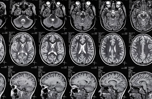 VA Disability for Traumatic Brain Injury