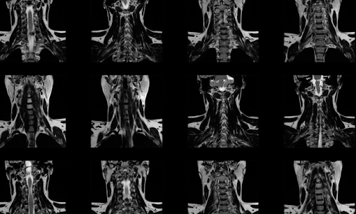 Radiculopathy VA Claim