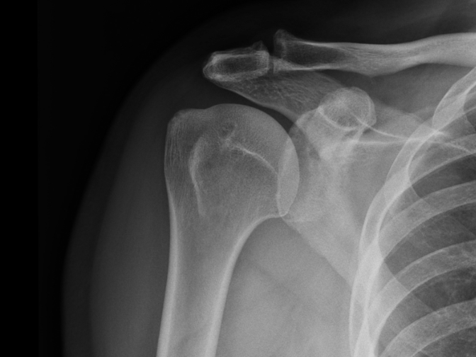 Shoulder Conditions